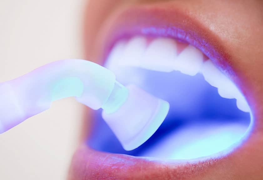 Man getting veneer check