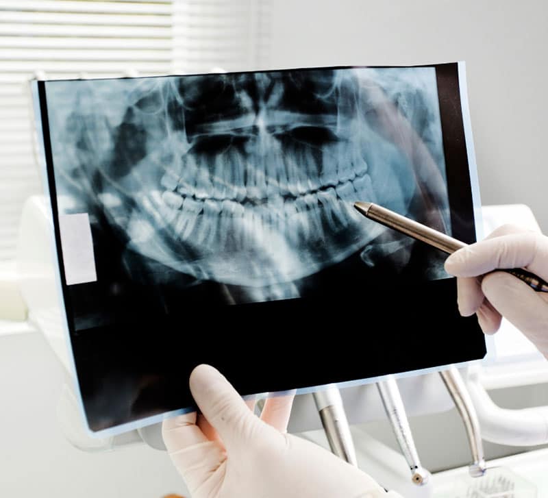 Dental X-Ray